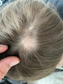 Before - “Volví a ver crecer mi cabello donde antes se caía”